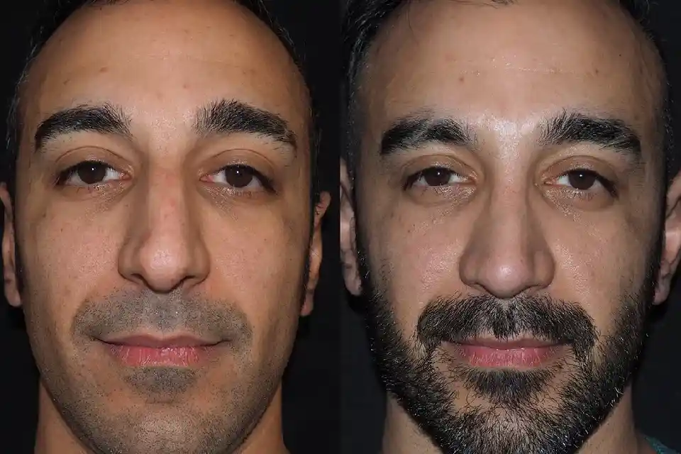 Nose Job in Dubai